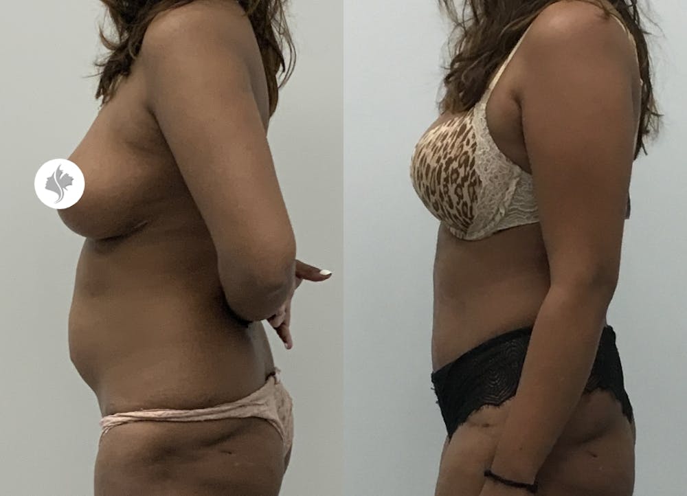 This is one of our beautiful tummy tuck patient #35