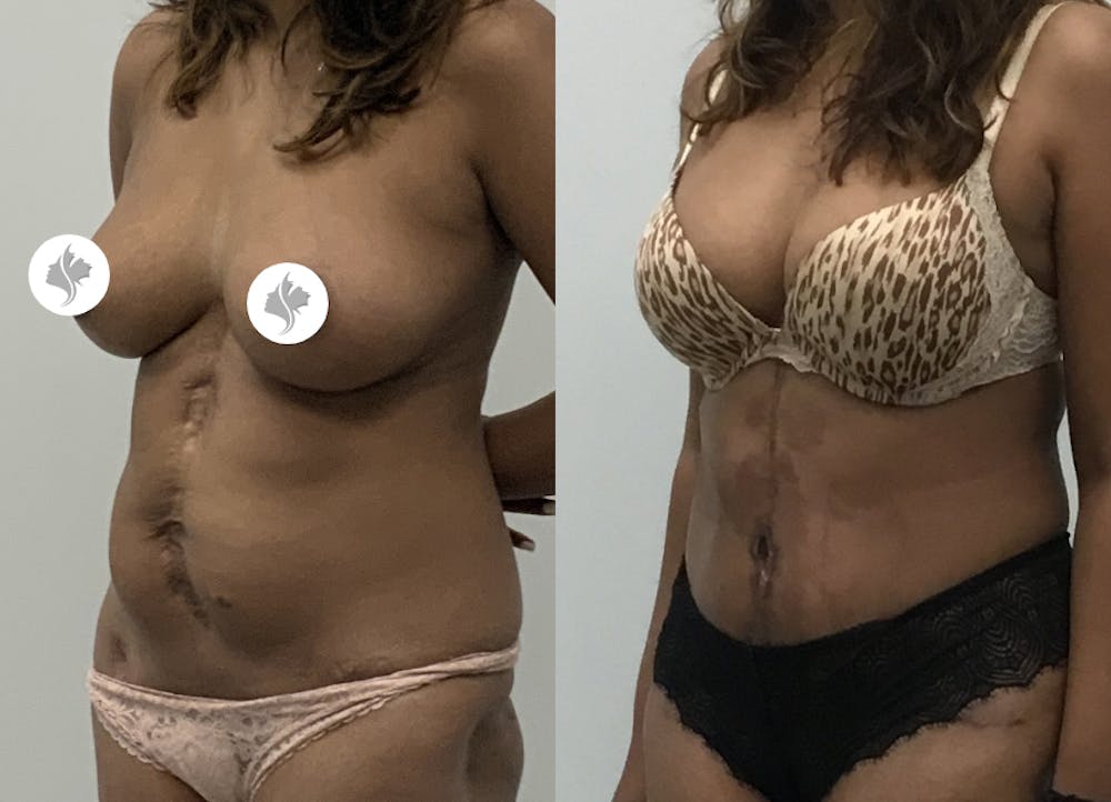 This is one of our beautiful tummy tuck patient #35