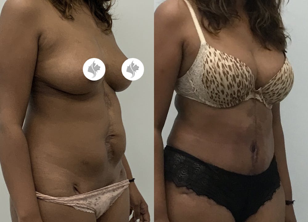 This is one of our beautiful tummy tuck patient #35