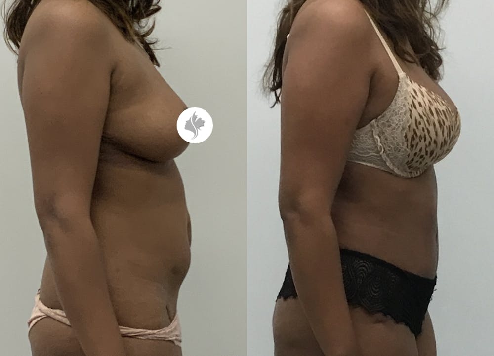 This is one of our beautiful tummy tuck patient #35