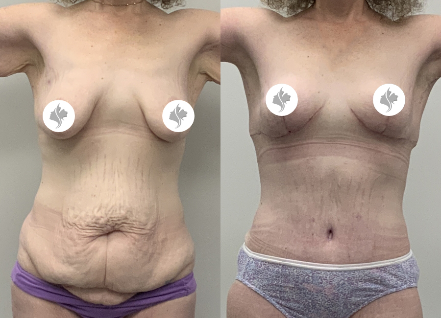 This is one of our beautiful post-bariatric body contouring patient 53