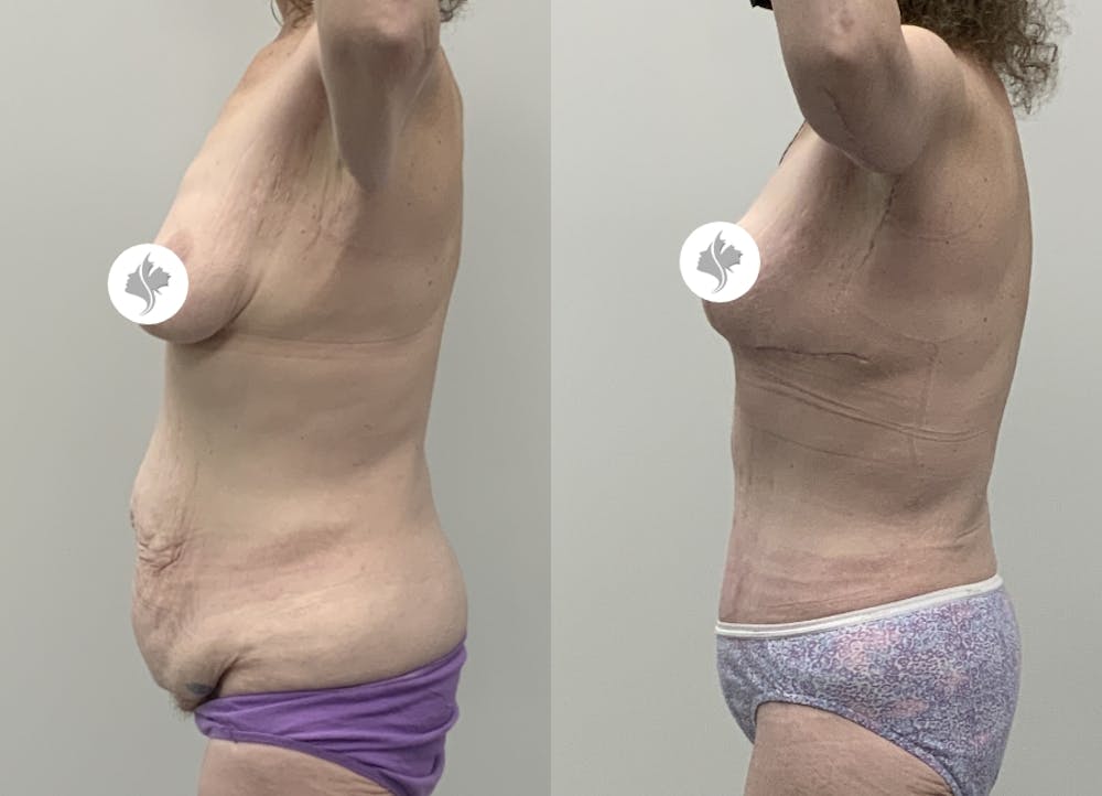 This is one of our beautiful tummy tuck patient #95