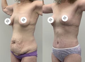 This is one of our beautiful post-bariatric body contouring patient 53