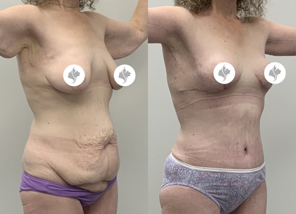 This is one of our beautiful post-bariatric body contouring patient #53