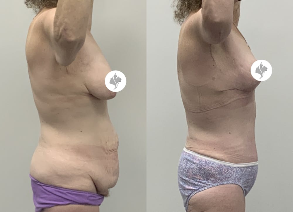 This is one of our beautiful post-bariatric body contouring patient #53