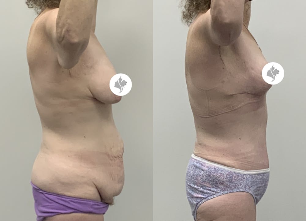 This is one of our beautiful tummy tuck patient #96