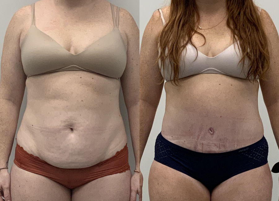 This is one of our beautiful tummy tuck patient 10