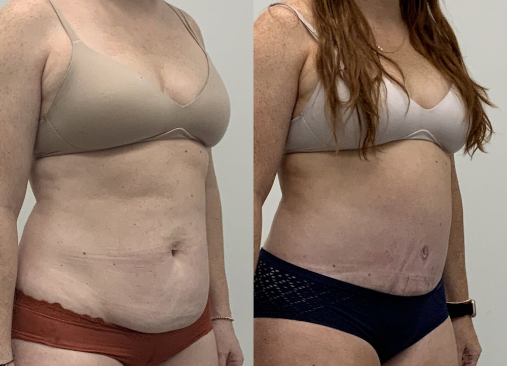 This is one of our beautiful tummy tuck patient #96