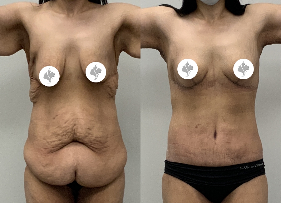 This is one of our beautiful post-bariatric body contouring patient 54