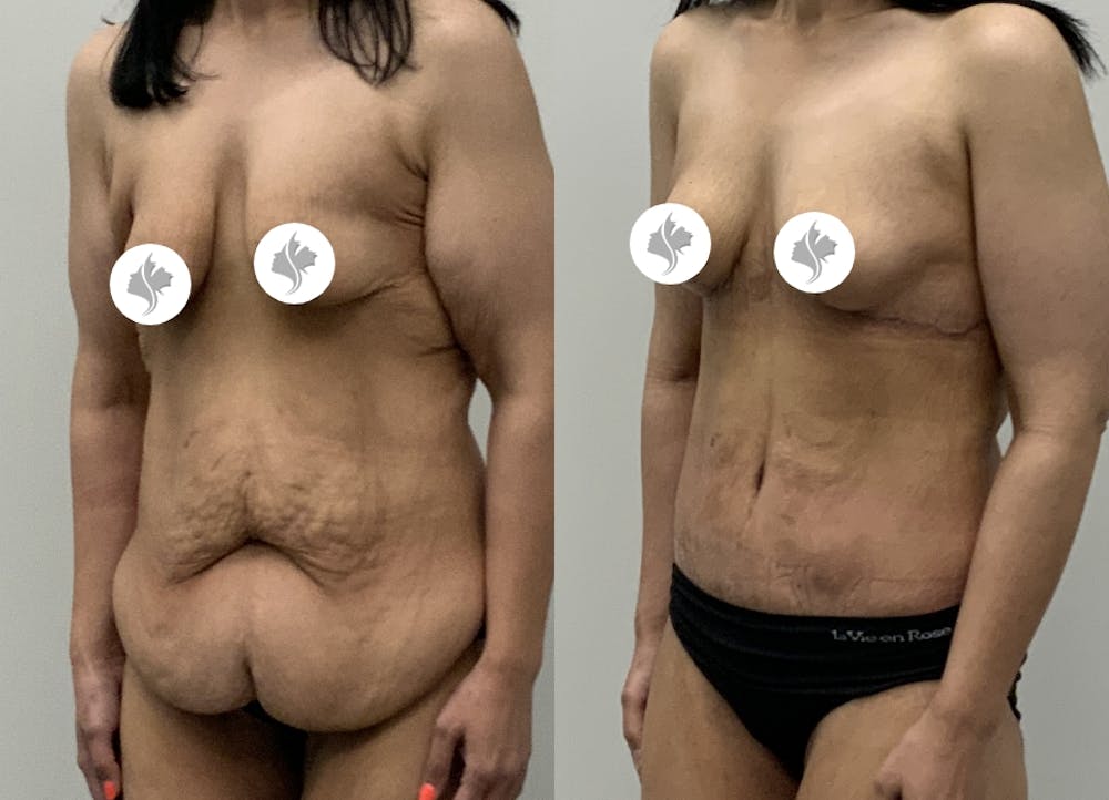 This is one of our beautiful post-bariatric body contouring patient #54