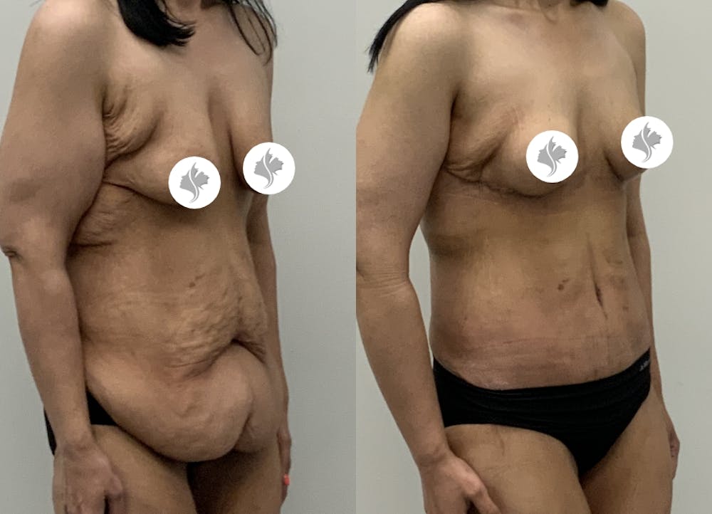 This is one of our beautiful tummy tuck patient #8