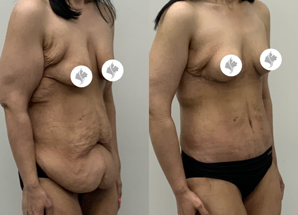 This is one of our beautiful post-bariatric body contouring patient #54