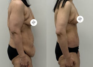 This is one of our beautiful post-bariatric body contouring patient 54