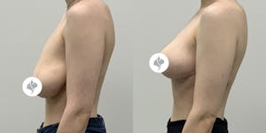 This is one of our beautiful breast reduction patient 16