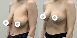 This is one of our beautiful breast reduction patient 16