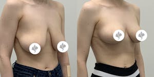 This is one of our beautiful breast reduction patient 16