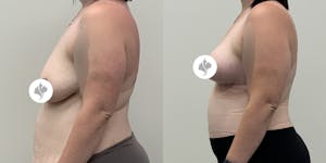 This is one of our beautiful breast reduction patient 17