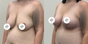 This is one of our beautiful breast reduction patient 17