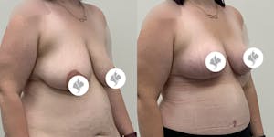 This is one of our beautiful breast reduction patient 17