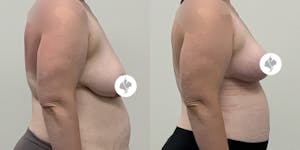 This is one of our beautiful breast reduction patient 17