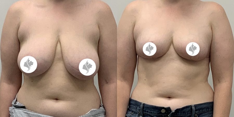 This is one of our beautiful breast asymmetry correction patient 16