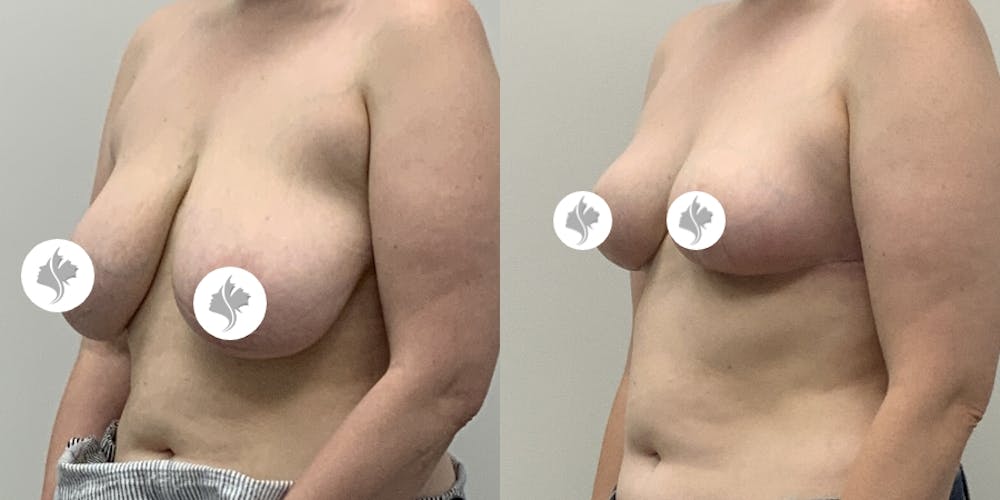 This is one of our beautiful breast asymmetry correction patient #16