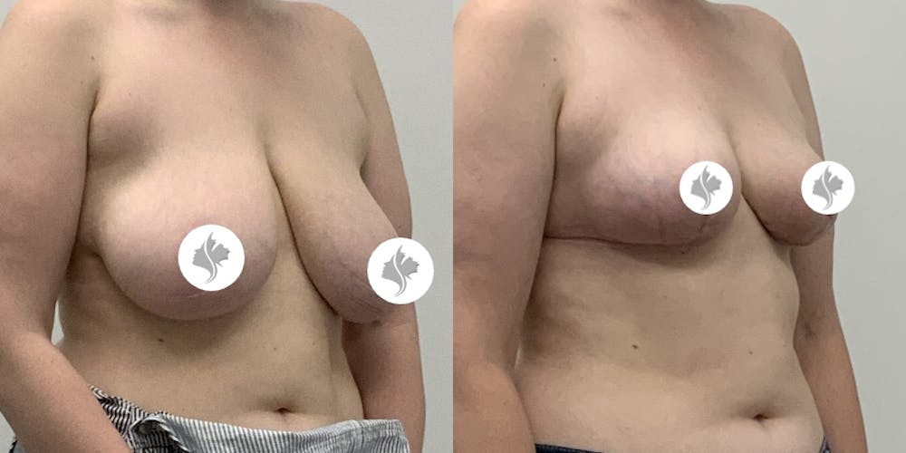 This is one of our beautiful breast asymmetry correction patient #16