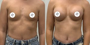This is one of our beautiful breast augmentation patient 7