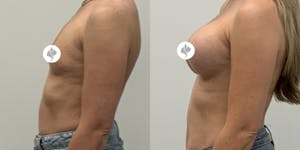 This is one of our beautiful breast augmentation patient 7