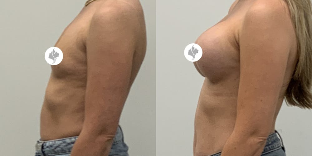 This is one of our beautiful breast augmentation patient #7