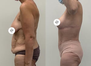 This is one of our beautiful post-bariatric body contouring patient 48