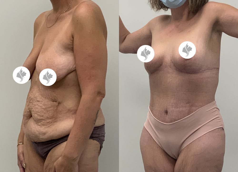 This is one of our beautiful post-bariatric body contouring patient #48