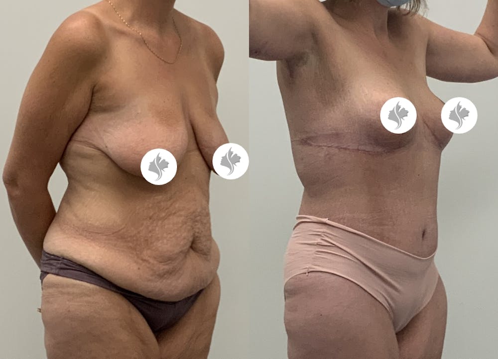 This is one of our beautiful post-bariatric body contouring patient #48