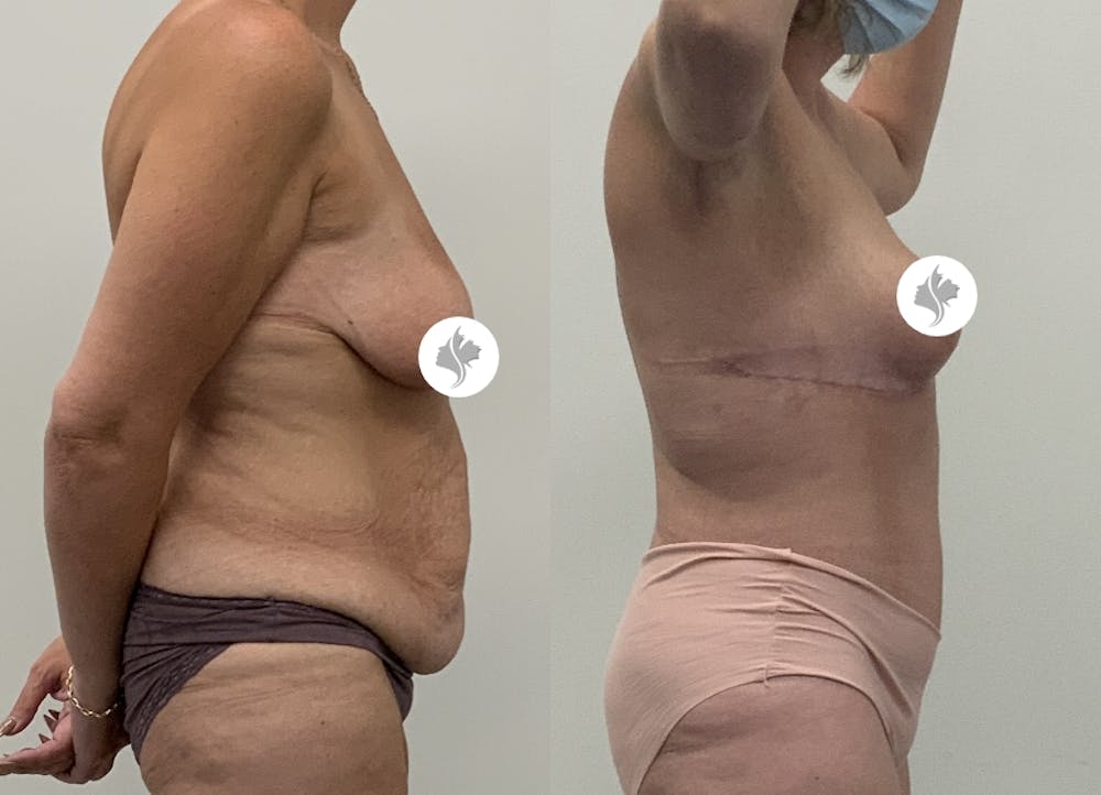 This is one of our beautiful tummy tuck patient #9