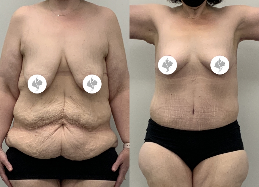 This is one of our beautiful post-bariatric body contouring patient 55