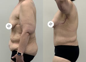This is one of our beautiful post-bariatric body contouring patient 55