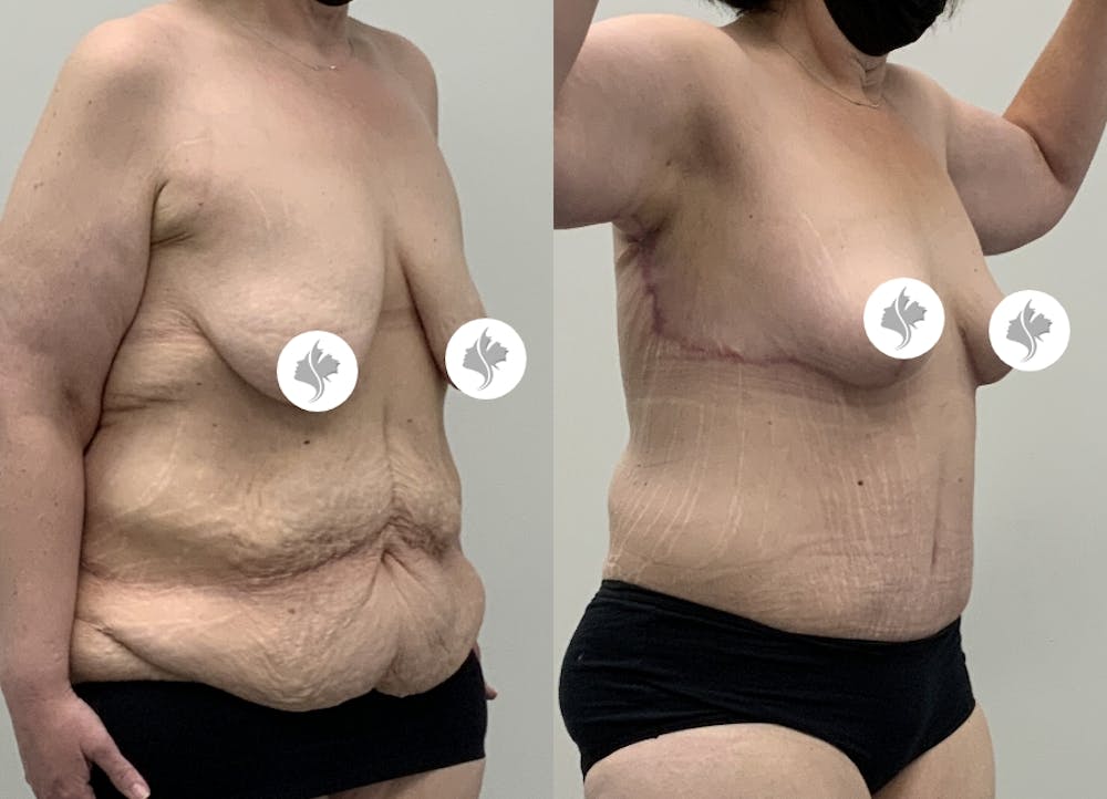 This is one of our beautiful post-bariatric body contouring patient #55
