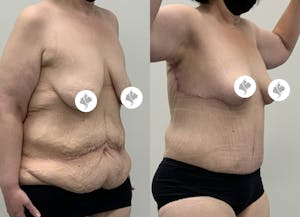 This is one of our beautiful post-bariatric body contouring patient 55