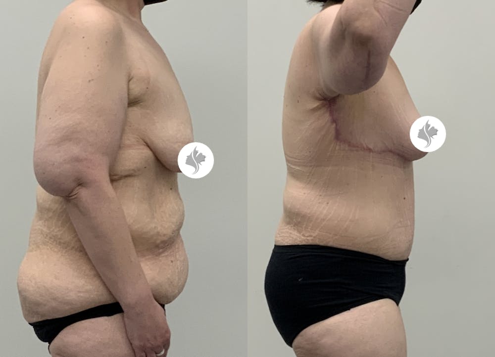 This is one of our beautiful post-bariatric body contouring patient #55