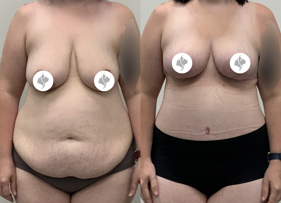 This is one of our beautiful post-bariatric body contouring patient 56