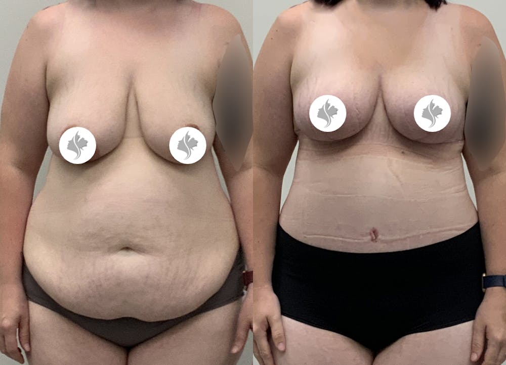 This is one of our beautiful post-bariatric body contouring patient #56