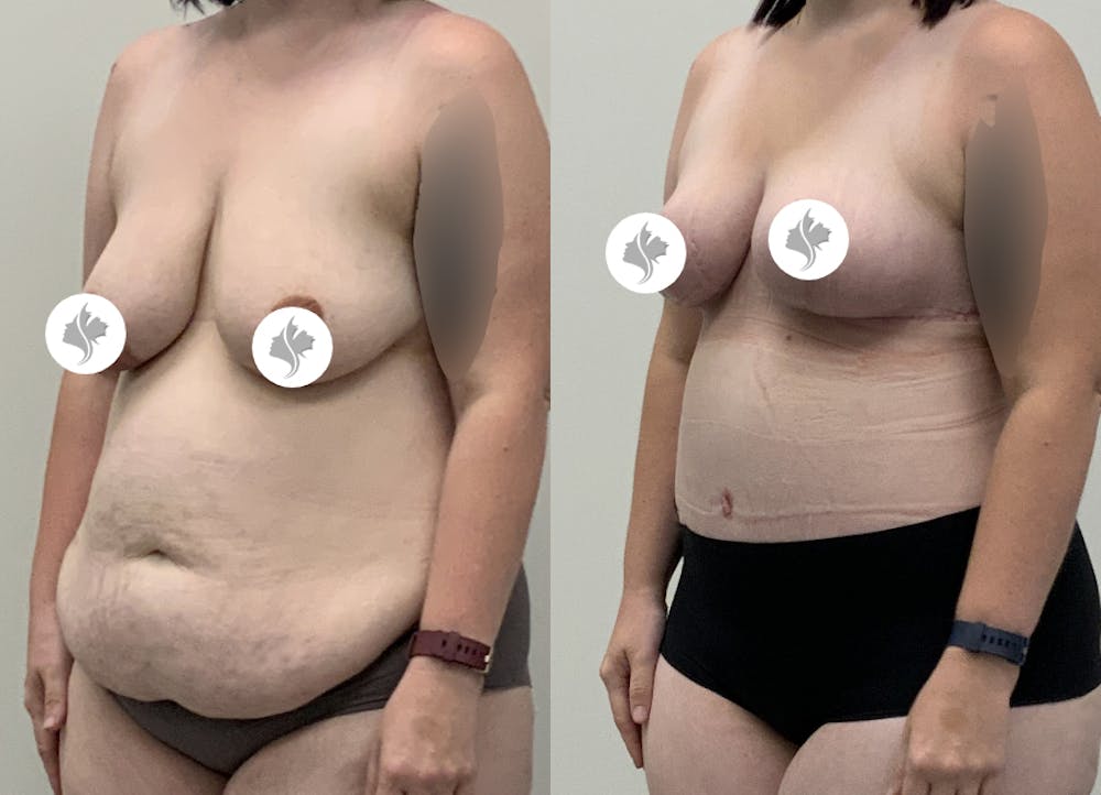 This is one of our beautiful post-bariatric body contouring patient #56