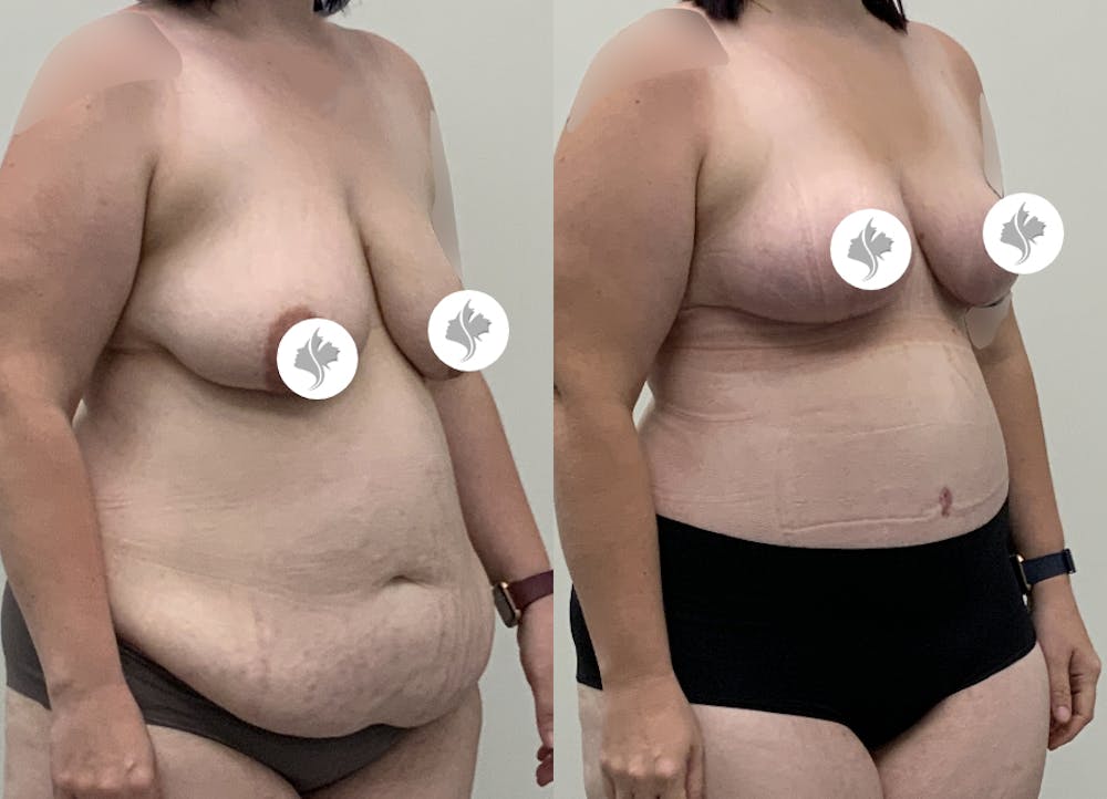 This is one of our beautiful post-bariatric body contouring patient #56