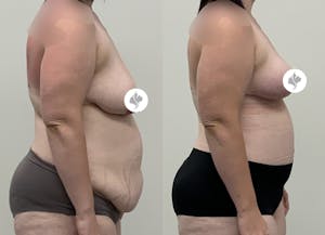 This is one of our beautiful post-bariatric body contouring patient 56