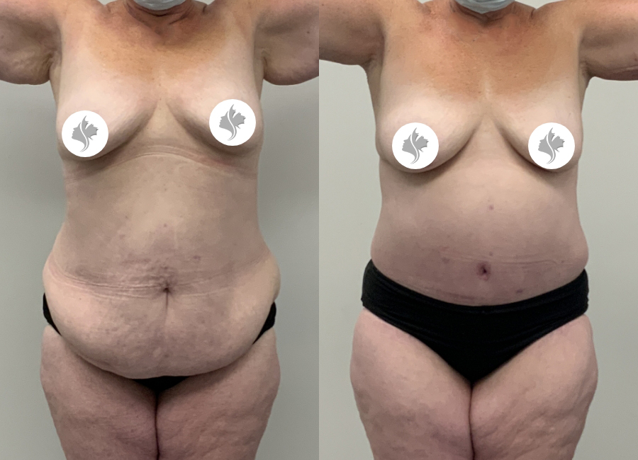 This is one of our beautiful post-bariatric body contouring patient 58