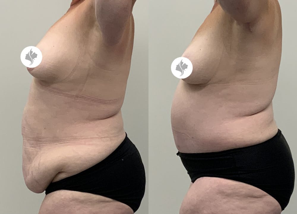 This is one of our beautiful post-bariatric body contouring patient #58