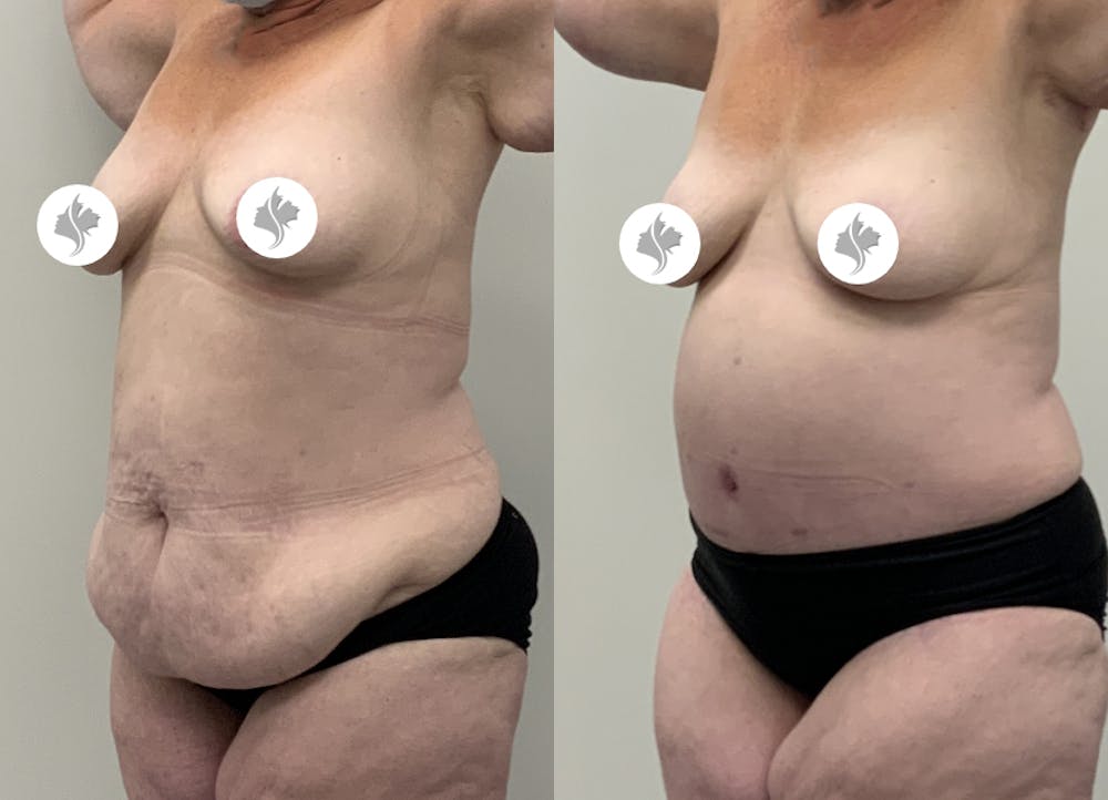 This is one of our beautiful post-bariatric body contouring patient #58