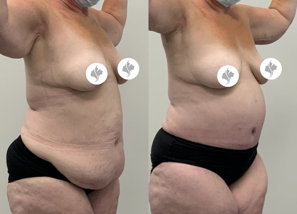 This is one of our beautiful post-bariatric body contouring patient #58