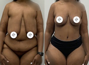 This is one of our beautiful post-bariatric body contouring patient 59