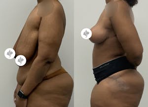 This is one of our beautiful post-bariatric body contouring patient 59